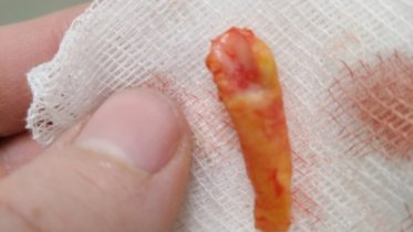 Фото: В Череповце от инсульта спасли женщину