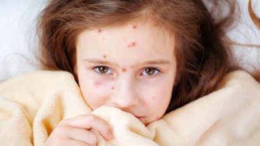 Фото: В Череповце зафиксировали первый случай инфицирования корью