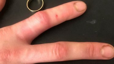 Фото: Череповчанке кольцо с пальца снимал спасатель