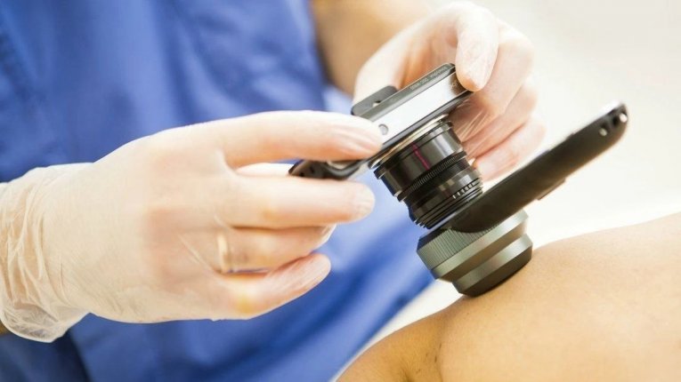 Фото: Череповчан приглашают на бесплатную диагностику меланомы