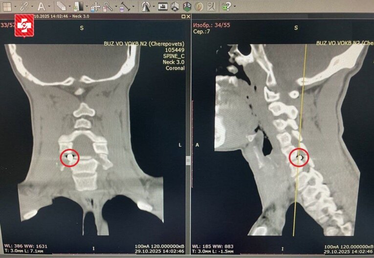 Фото: Череповецкие нейрохирурги провели операцию по извлечению осколка из позвоночника бойца СВО
