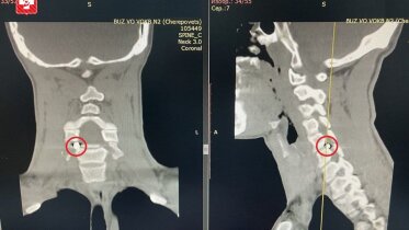 Фото: Череповецкие нейрохирурги провели операцию по извлечению осколка из позвоночника бойца СВО